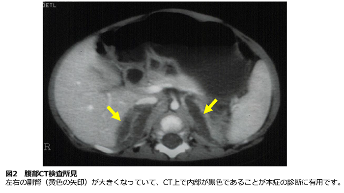 図2 腹部CT検査所見